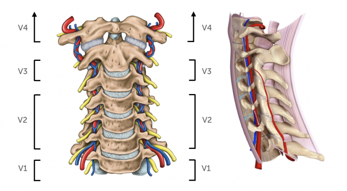 Artery vertebral Syndrome of